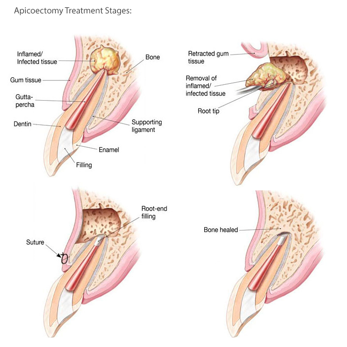 Apicoectomy & Root End Surgery Scripps Mesa Endodontics