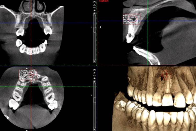 3D Imaging: CBCT