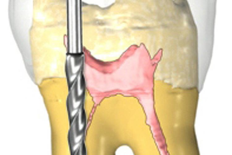 Cleaning & Shaping Canals