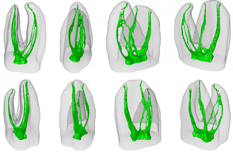 Anatomical Complexity: Challenges In Root Canal Therapy