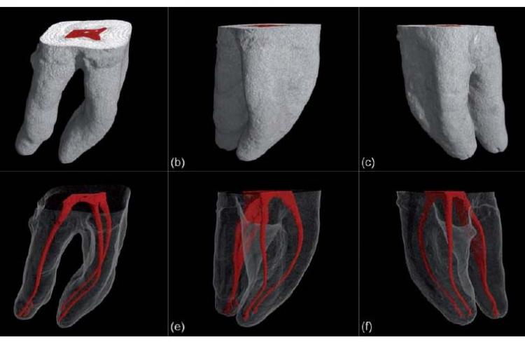 Obturation & Filling of Canals