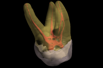 3D Imaging : Complexity of Canals