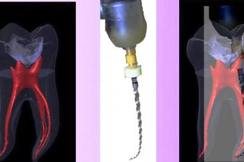 Root Canal Complexity & Rotary Instrumentation