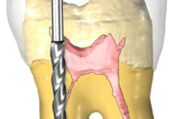 Cleaning & Shaping Canals