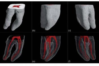 Obturation & Filling of Canals